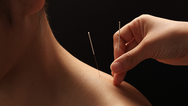 Acupuncture is best way to treat back pain, study finds